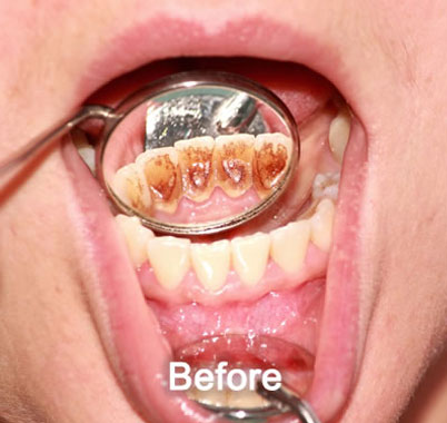 North York Dentist | Dental Cleaning | After