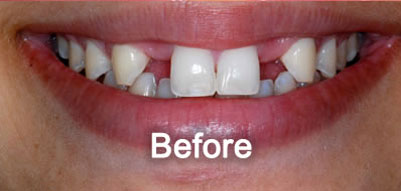 North York Dentist | Dental Implants | Before